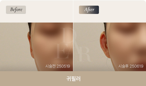 ear-bna-filler-01-1