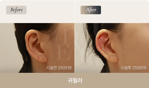 ear-bna-filler-01