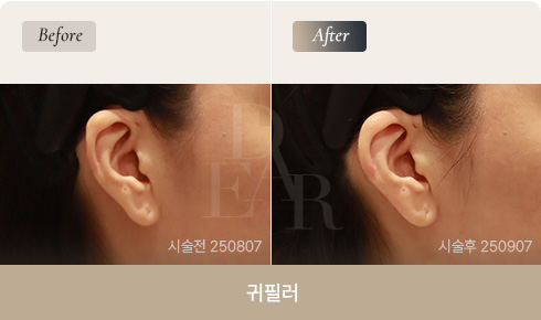 ear-bna-filler-02