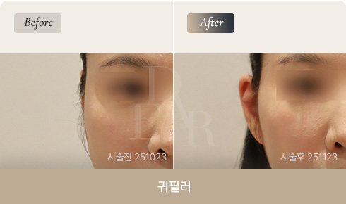 ear-bna-filler-03-1