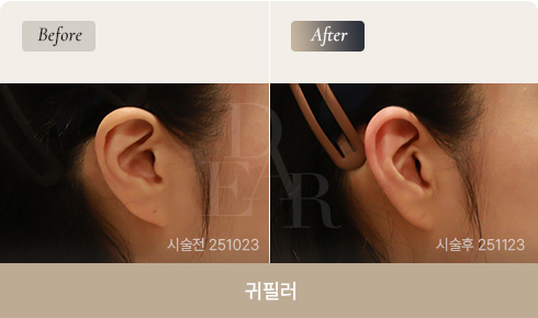 ear-bna-filler-03