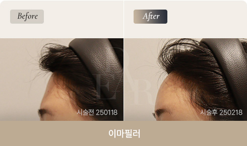 forehead-filler-bna-01-1