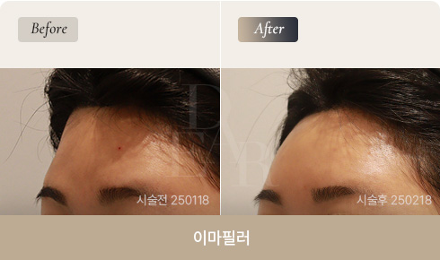 forehead-filler-bna-01