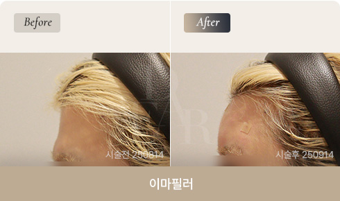 forehead-filler-bna-02-1