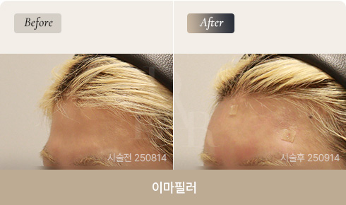 forehead-filler-bna-02