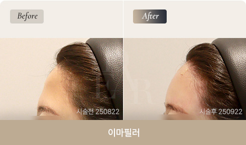 forehead-filler-bna-03-1