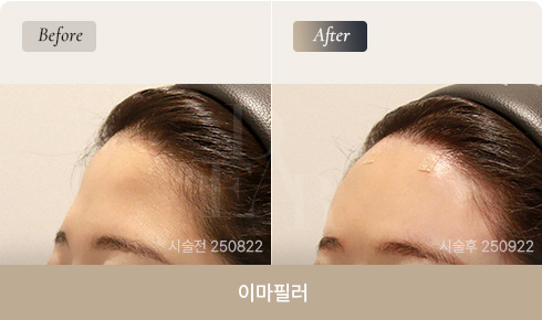 forehead-filler-bna-03
