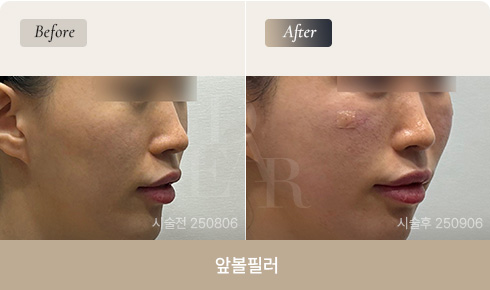 front-cheek-filler-bna-01-1