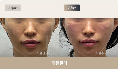 front-cheek-filler-bna-01