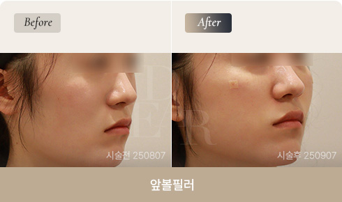 front-cheek-filler-bna-02-1