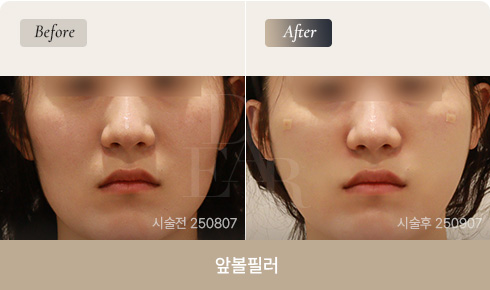 front-cheek-filler-bna-02