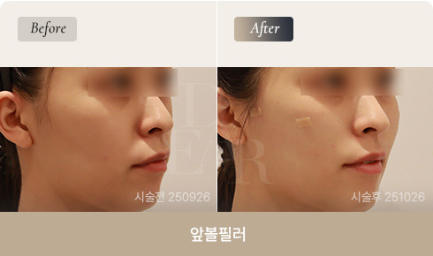 front-cheek-filler-bna-03-1