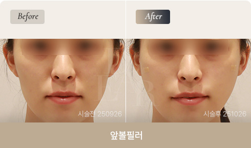 front-cheek-filler-bna-03