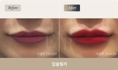 lip-filler-bna-01
