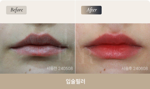 lip-filler-bna-02