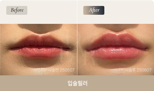 lip-filler-bna-03