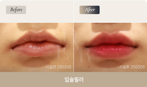 lip-filler-bna-04