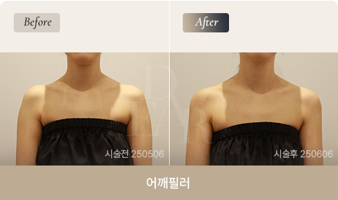 shoulder-filler-01-fin