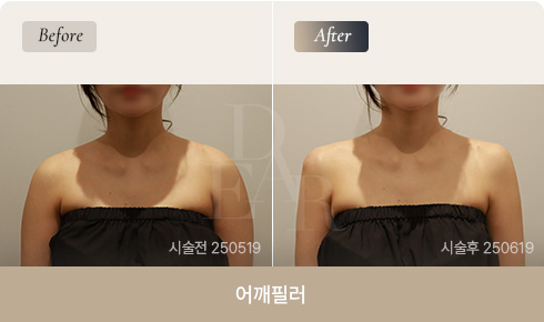 shoulder-filler-02-fin