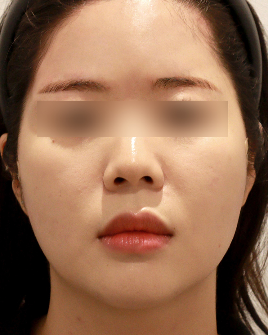 청담디어_옆볼필러_후