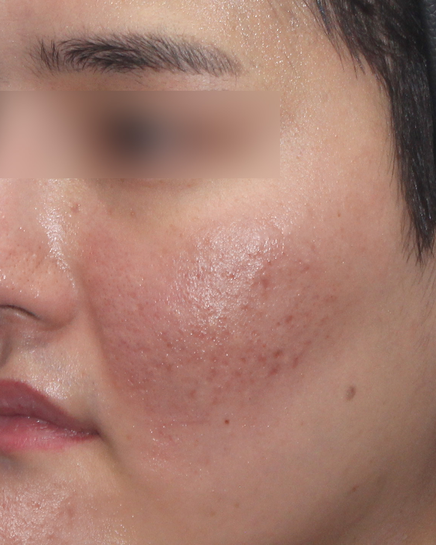 청담디어_흉터치료_전