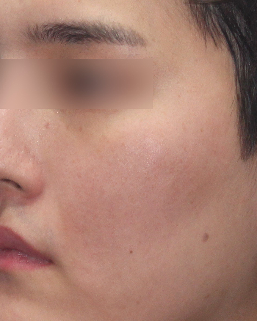 청담디어_흉터치료_후