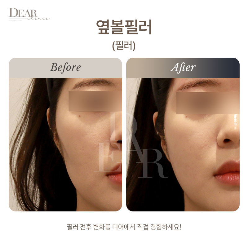 옆볼필러