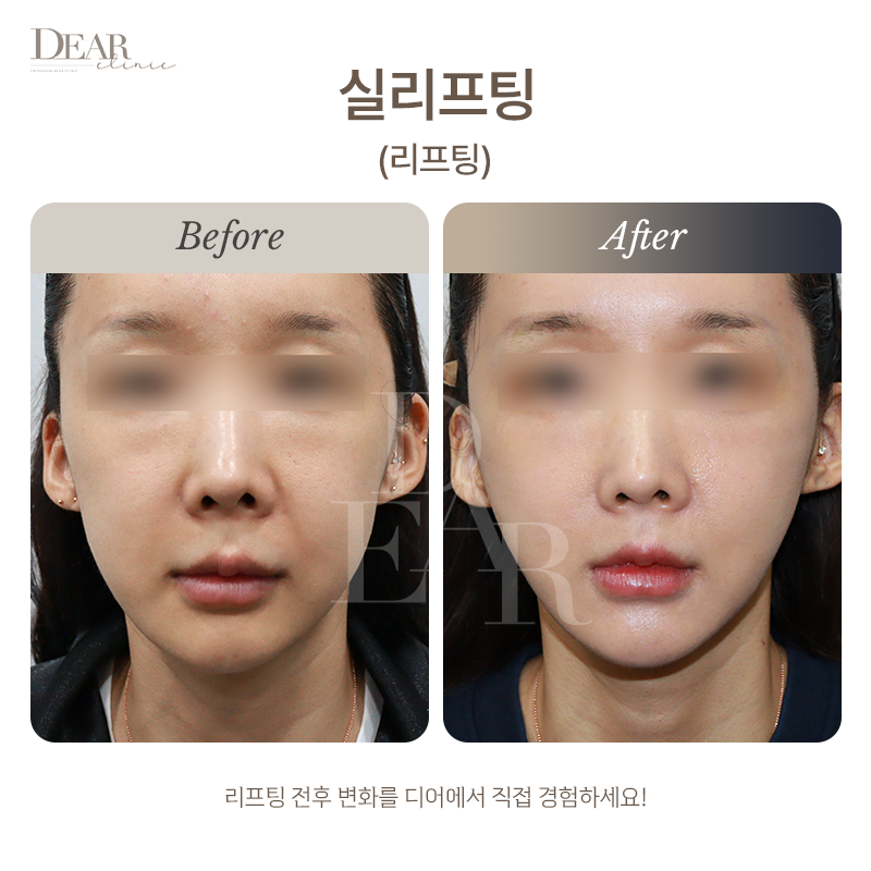 실리프팅