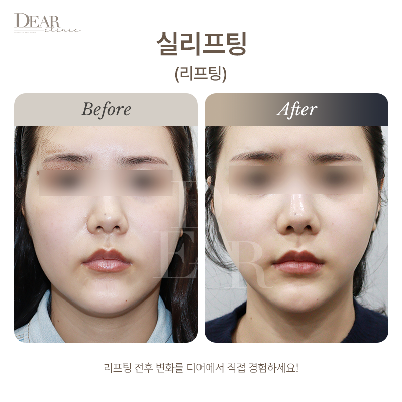 실리프팅