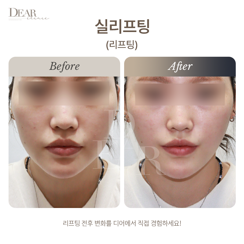 실리프팅
