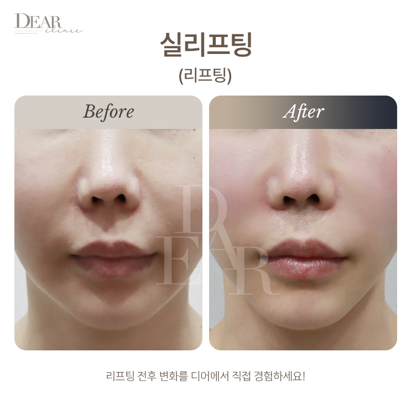 실리프팅