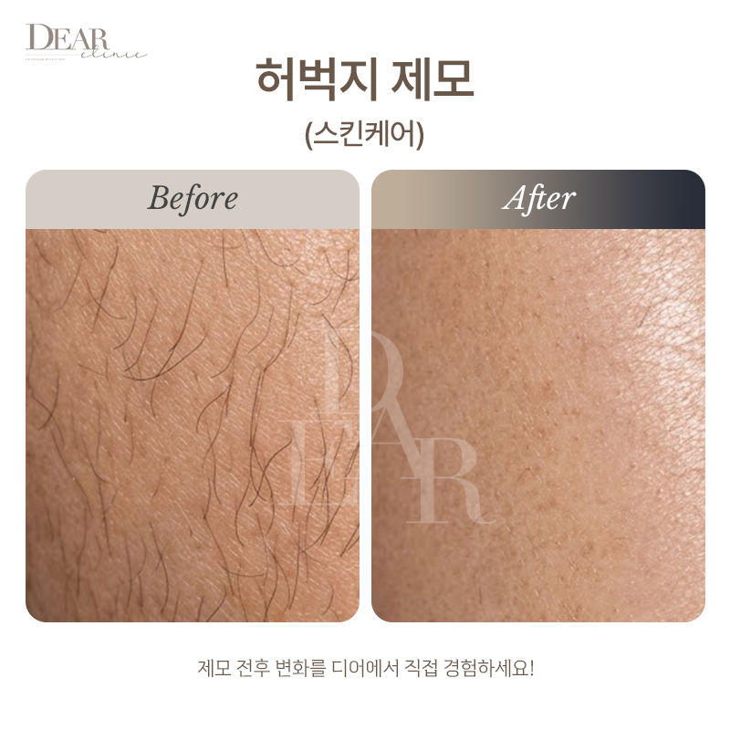 허벅지 제모