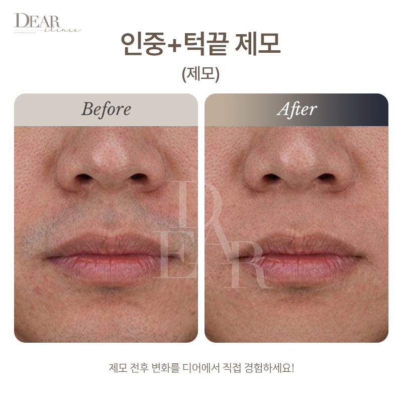 인중+턱끝 제모