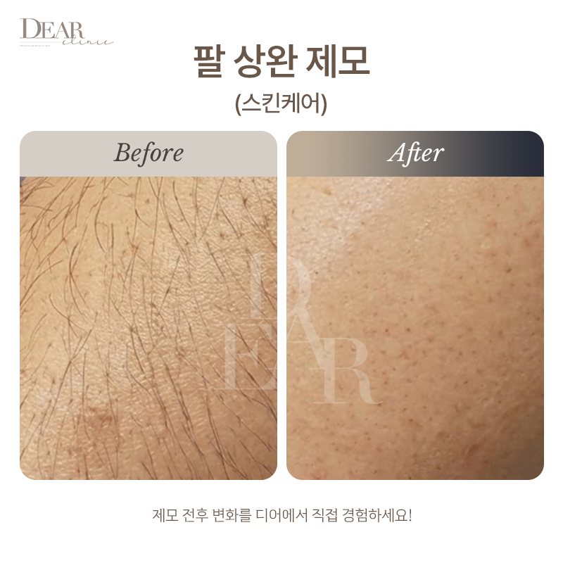 팔 상완 제모