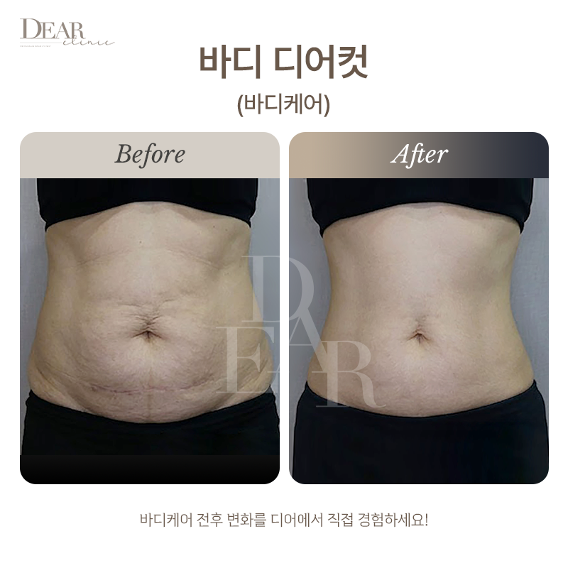 바디 디어컷