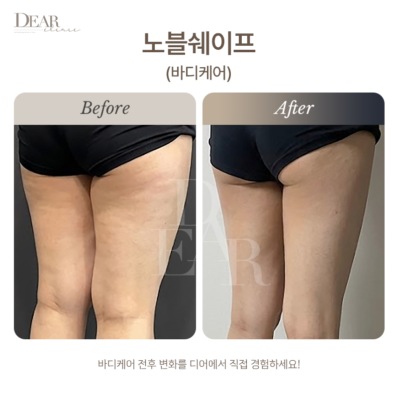 노블쉐이프