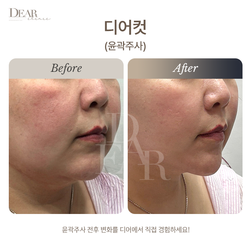 윤곽주사 디어컷