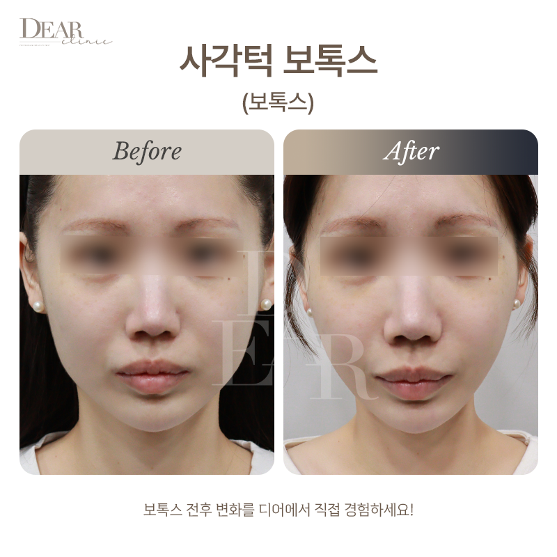 사각턱 보톡스