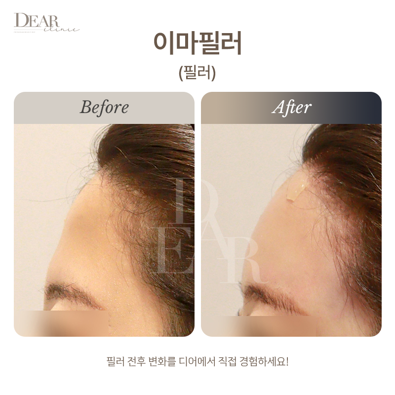 이마필러