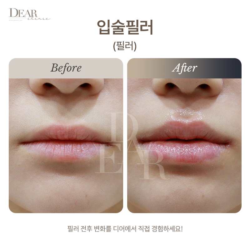 입술필러