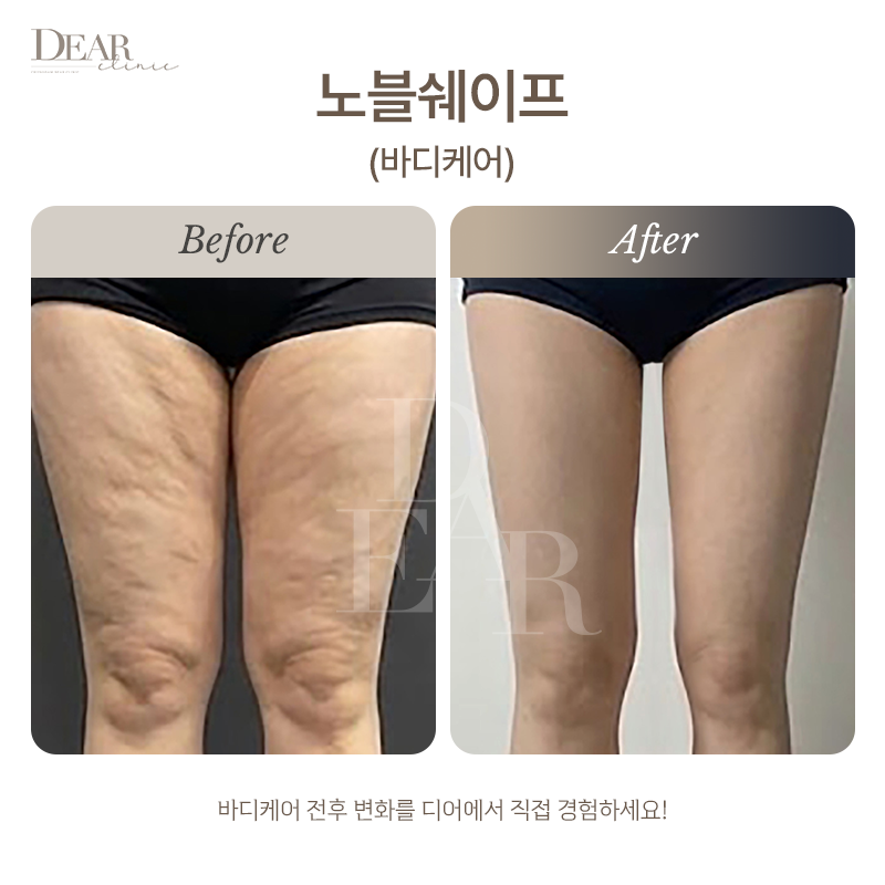 노블쉐이프