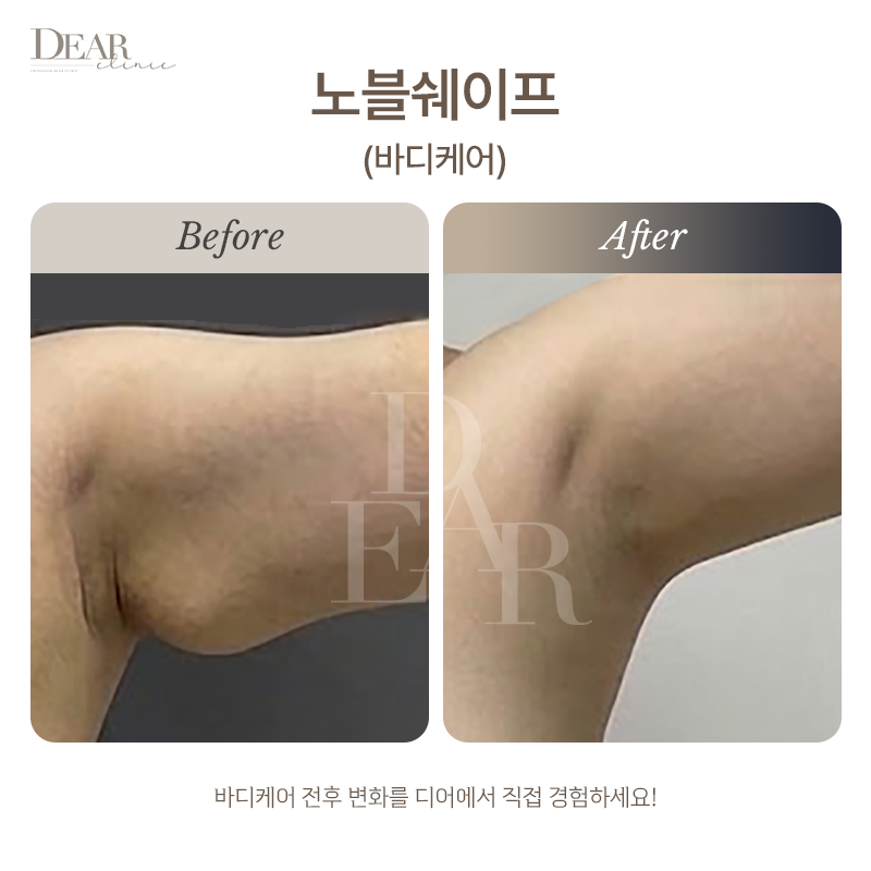 노블쉐이프