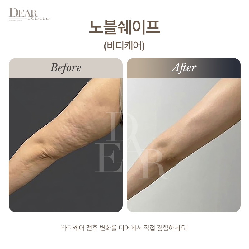노블쉐이프