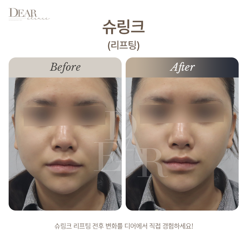 슈링크