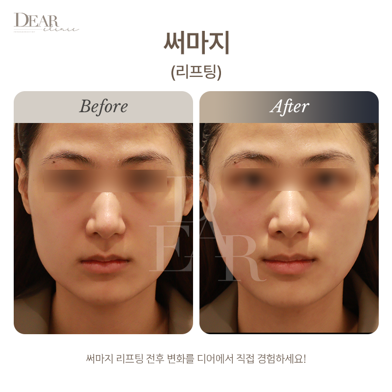 써마지
