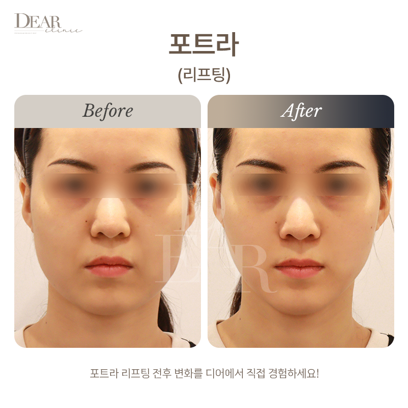 포트라