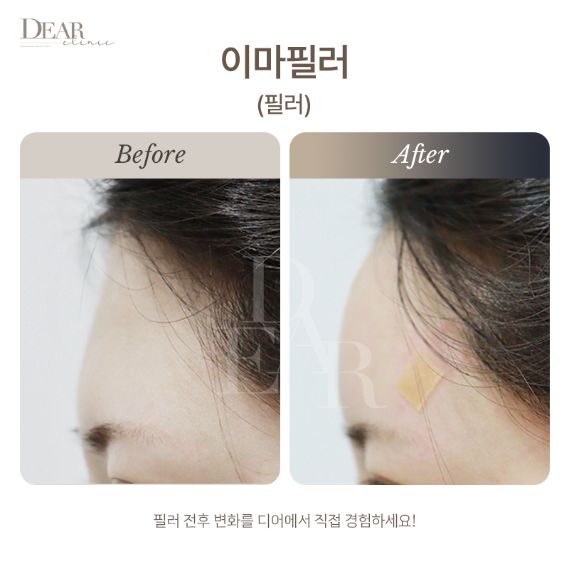 이마필러