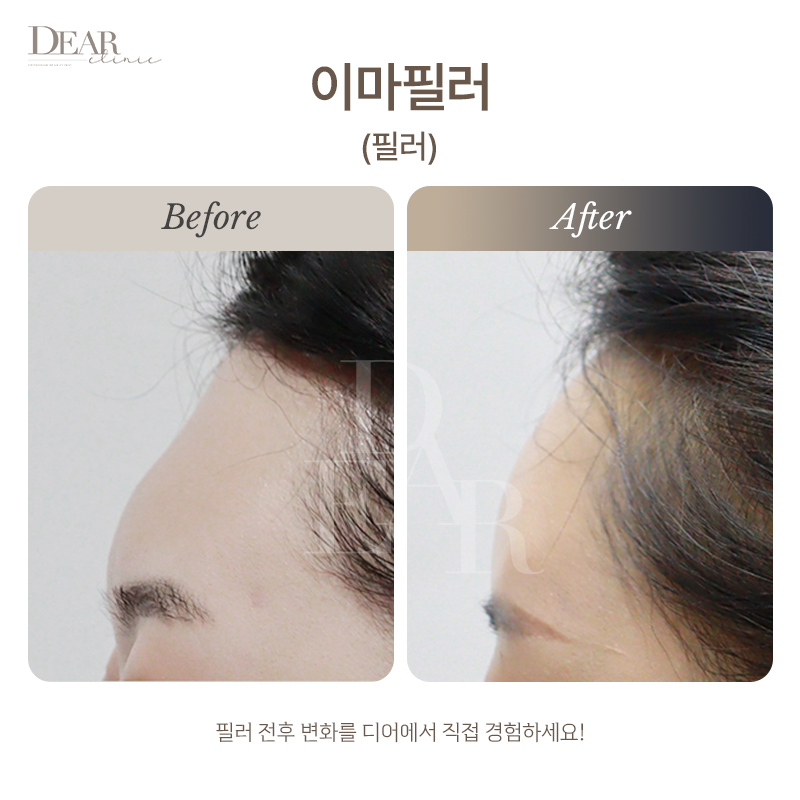이마필러