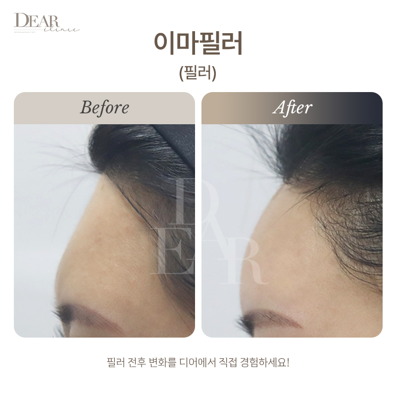 이마필러