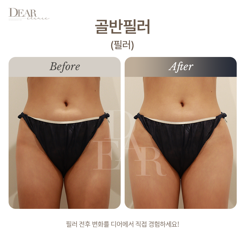 골반필러